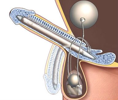 penis enlargement prosthesis